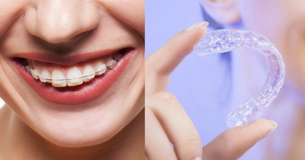 Invisalign Page